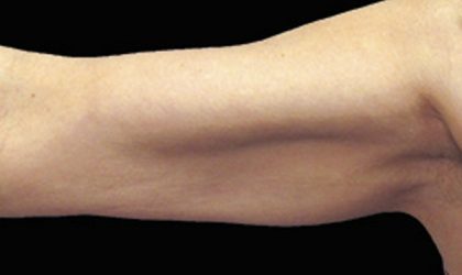 CoolSculpting Before & After Patient #1485