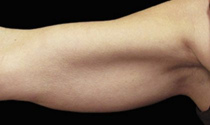 CoolSculpting Before & After Patient #1485