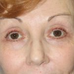 Eyelid Lift Before & After Patient #2260