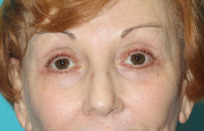 Eyelid Lift Before & After Patient #2260