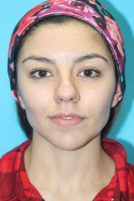 Rhinoplasty Before & After Patient #2120