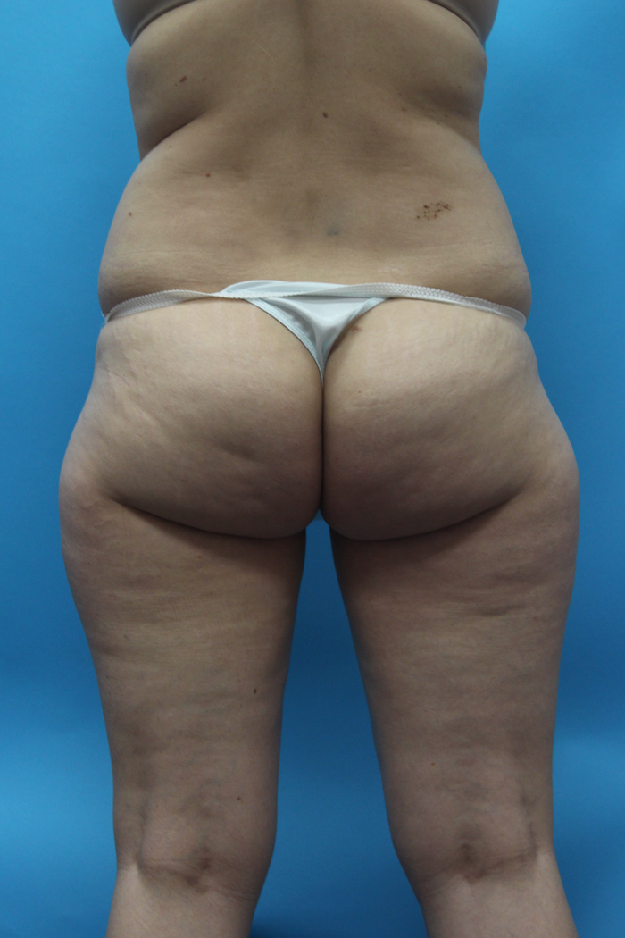 Power Assisted Liposuction Before & After Patient #2155