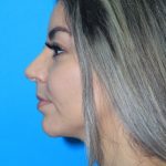 Rhinoplasty Before & After Patient #2120