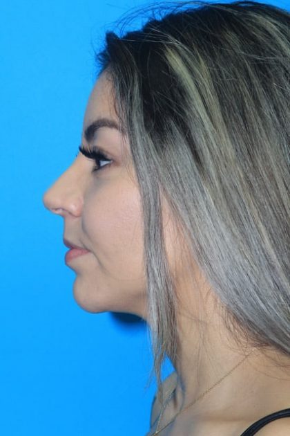 Rhinoplasty Before & After Patient #2120