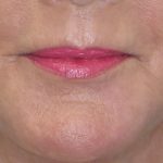 Laser Resurfacing Before & After Patient #2032