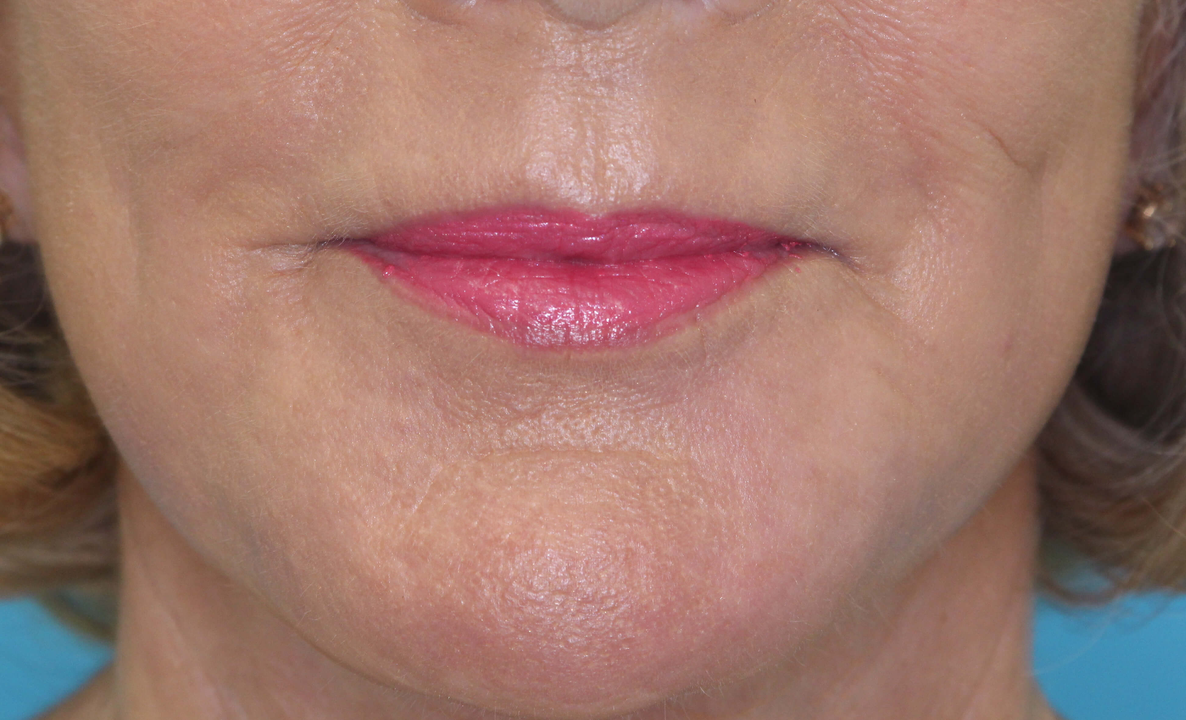 Laser Resurfacing Before & After Patient #2032