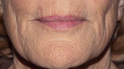 Laser Resurfacing Before & After Patient #2032
