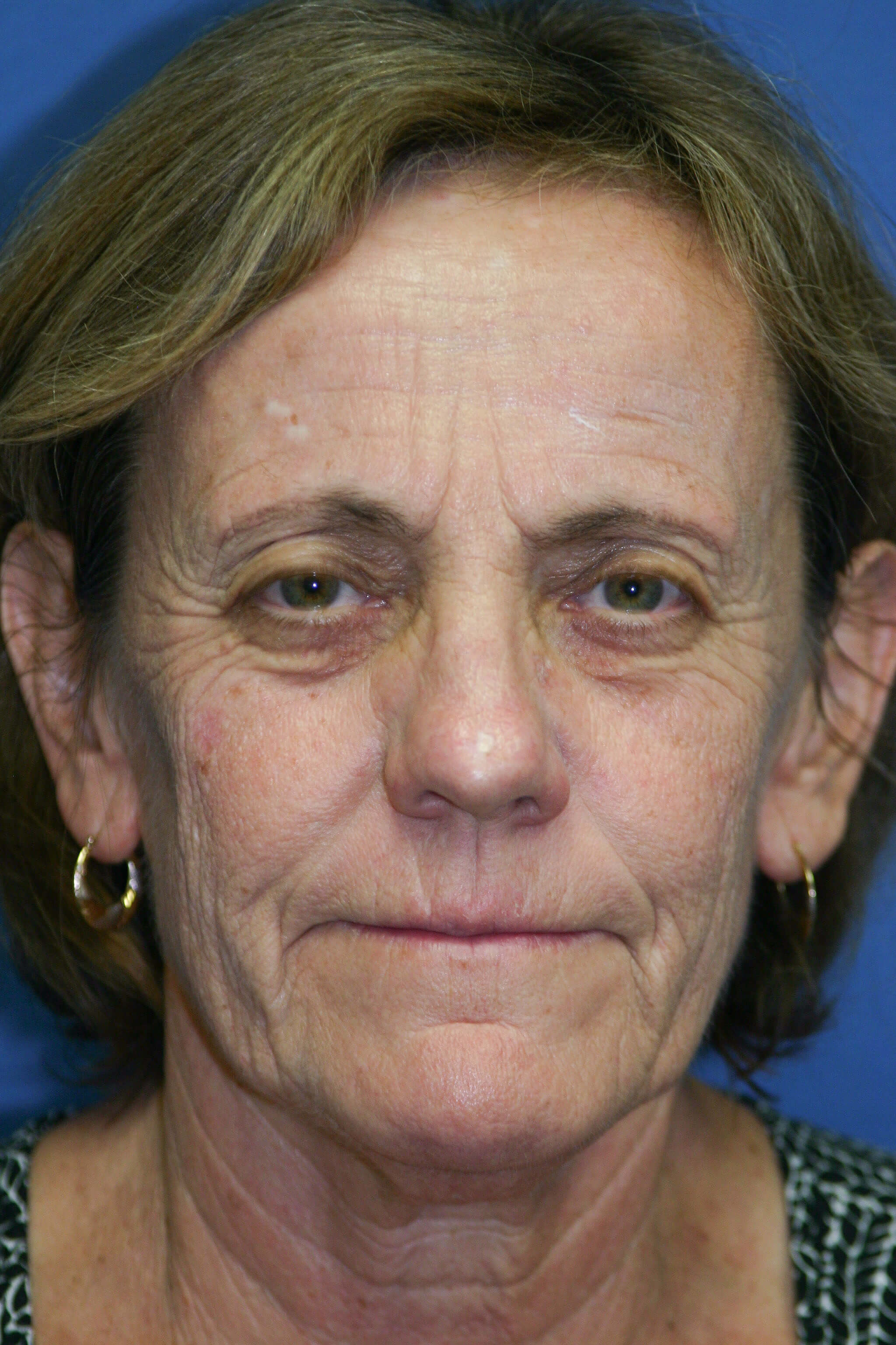 Laser Resurfacing Before & After Patient #2029