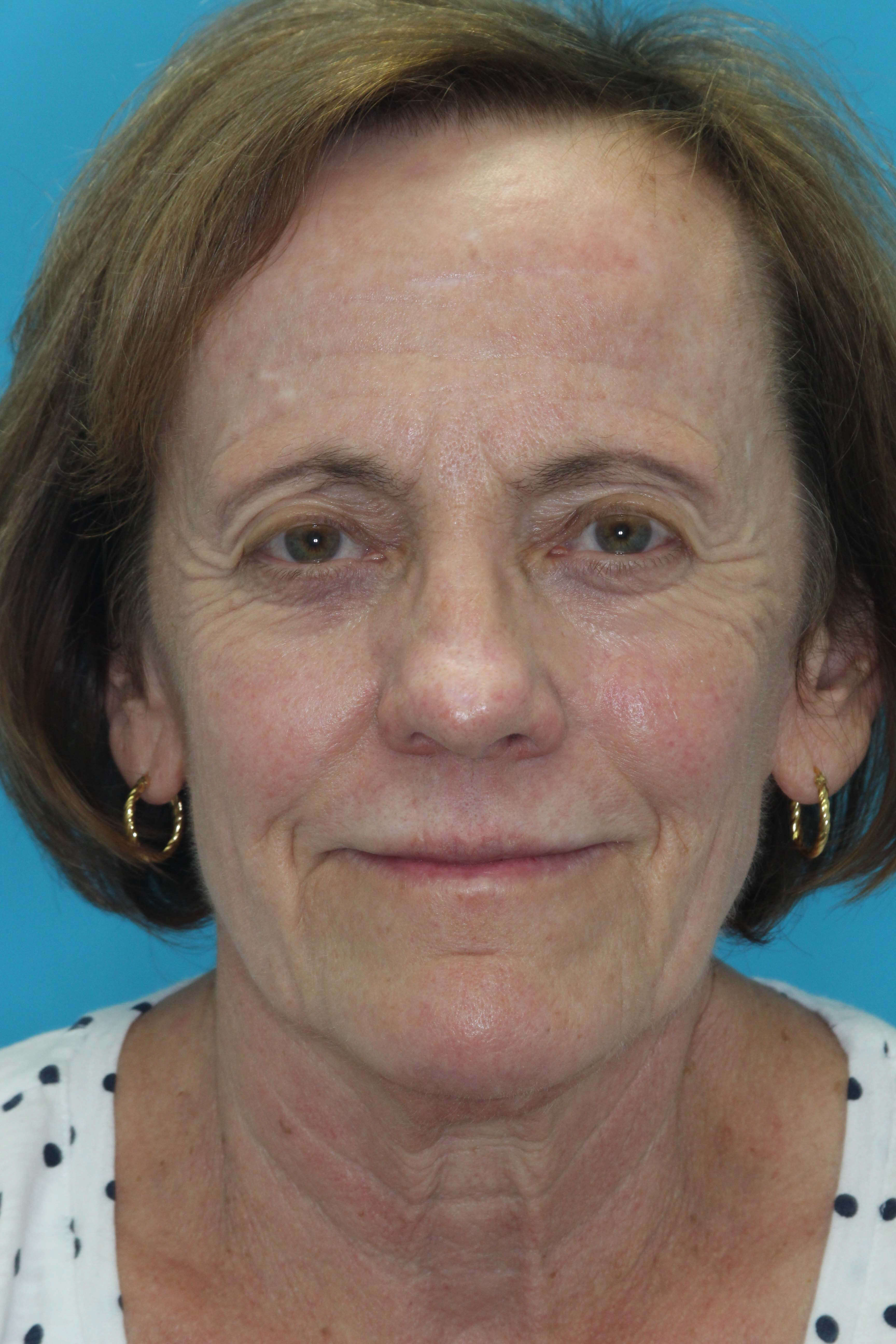 Laser Resurfacing Before & After Patient #2029