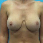 Breast Lift (Mastopexy) Before & After Patient #2226