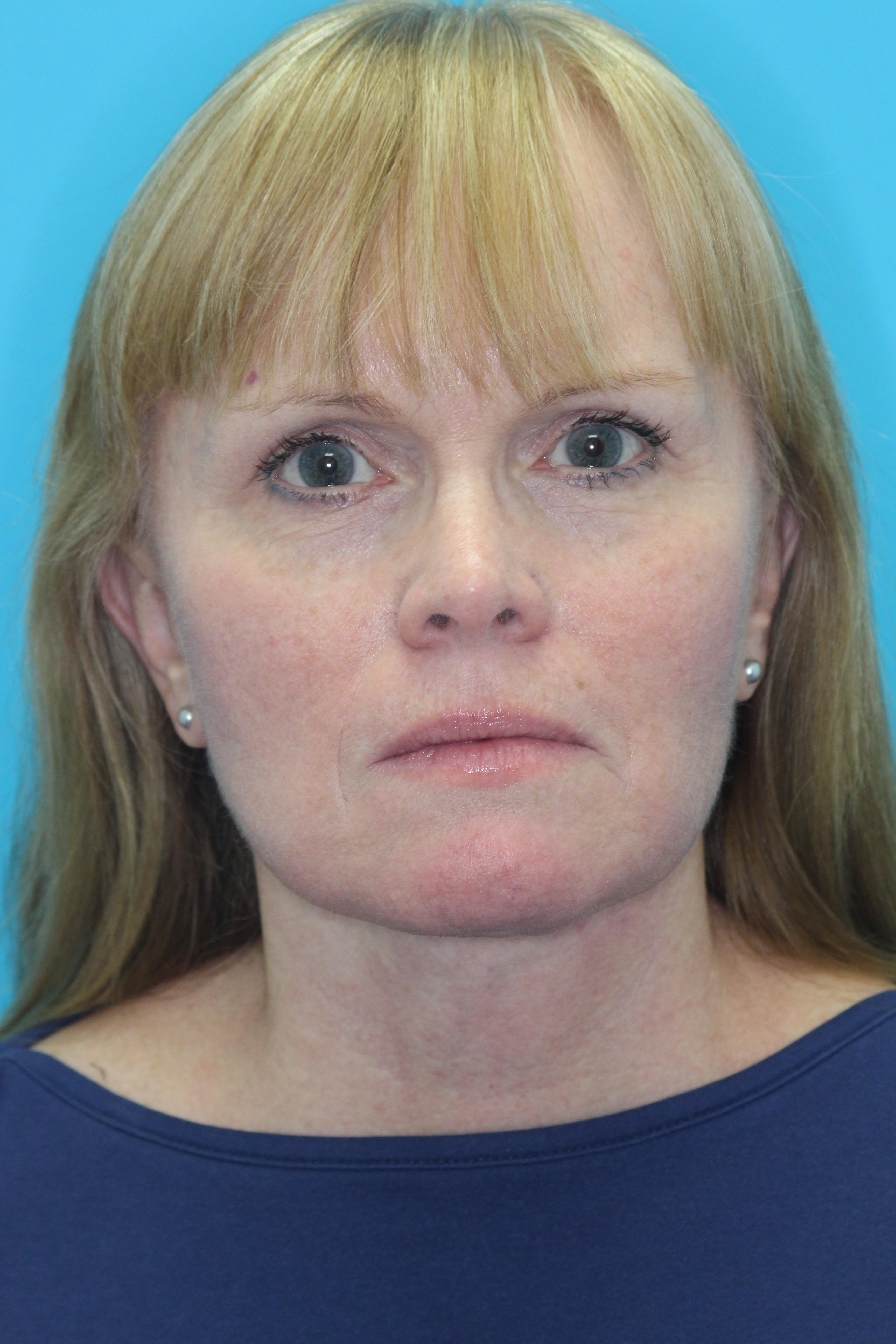Facelift Before & After Patient #2219