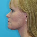 Facelift Before & After Patient #2219
