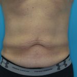 Tummy Tuck (Lipoabdominoplasty) Before & After Patient #1805