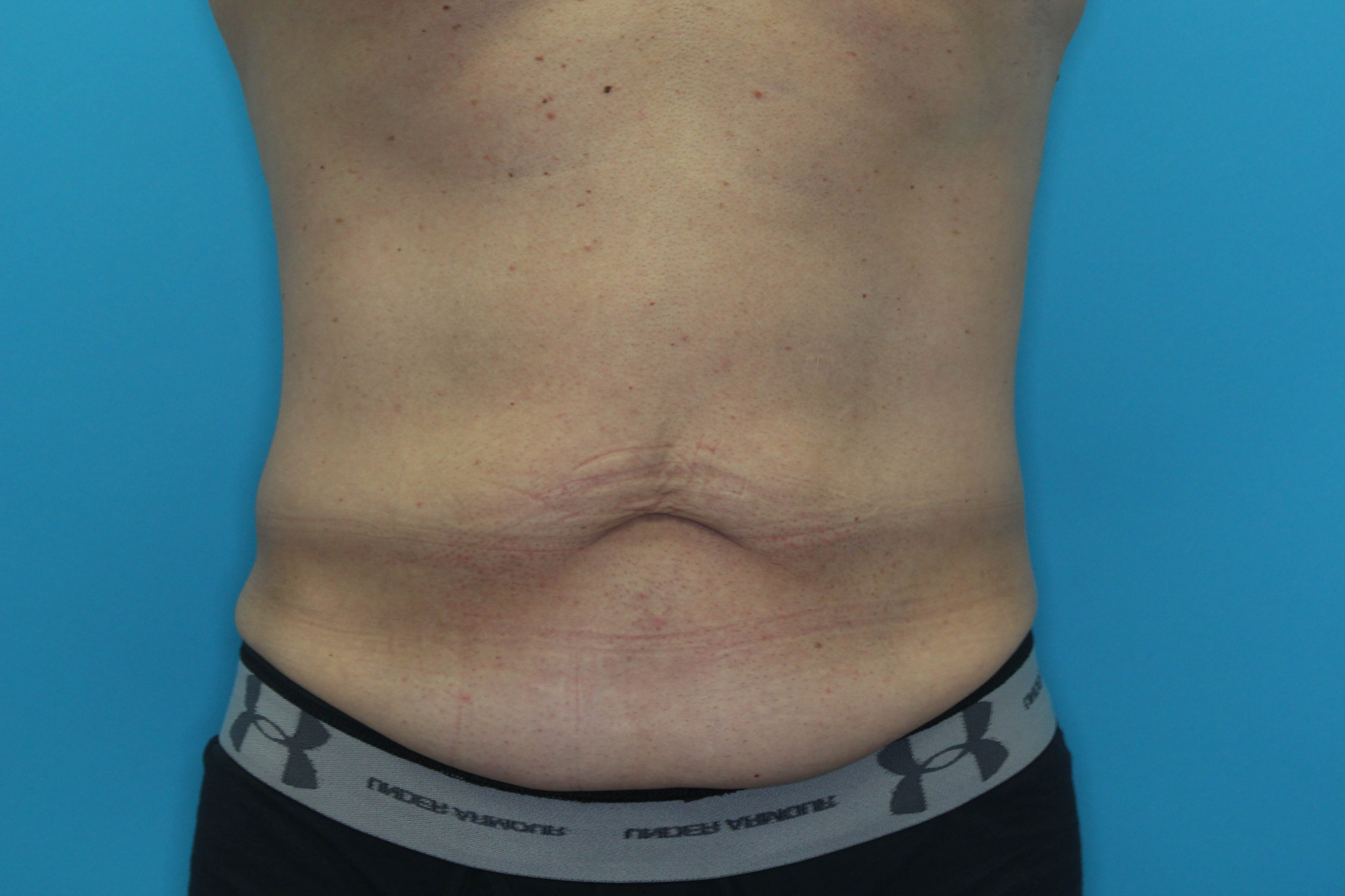Tummy Tuck (Lipoabdominoplasty) Before & After Patient #1805