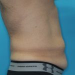 Tummy Tuck (Lipoabdominoplasty) Before & After Patient #1805