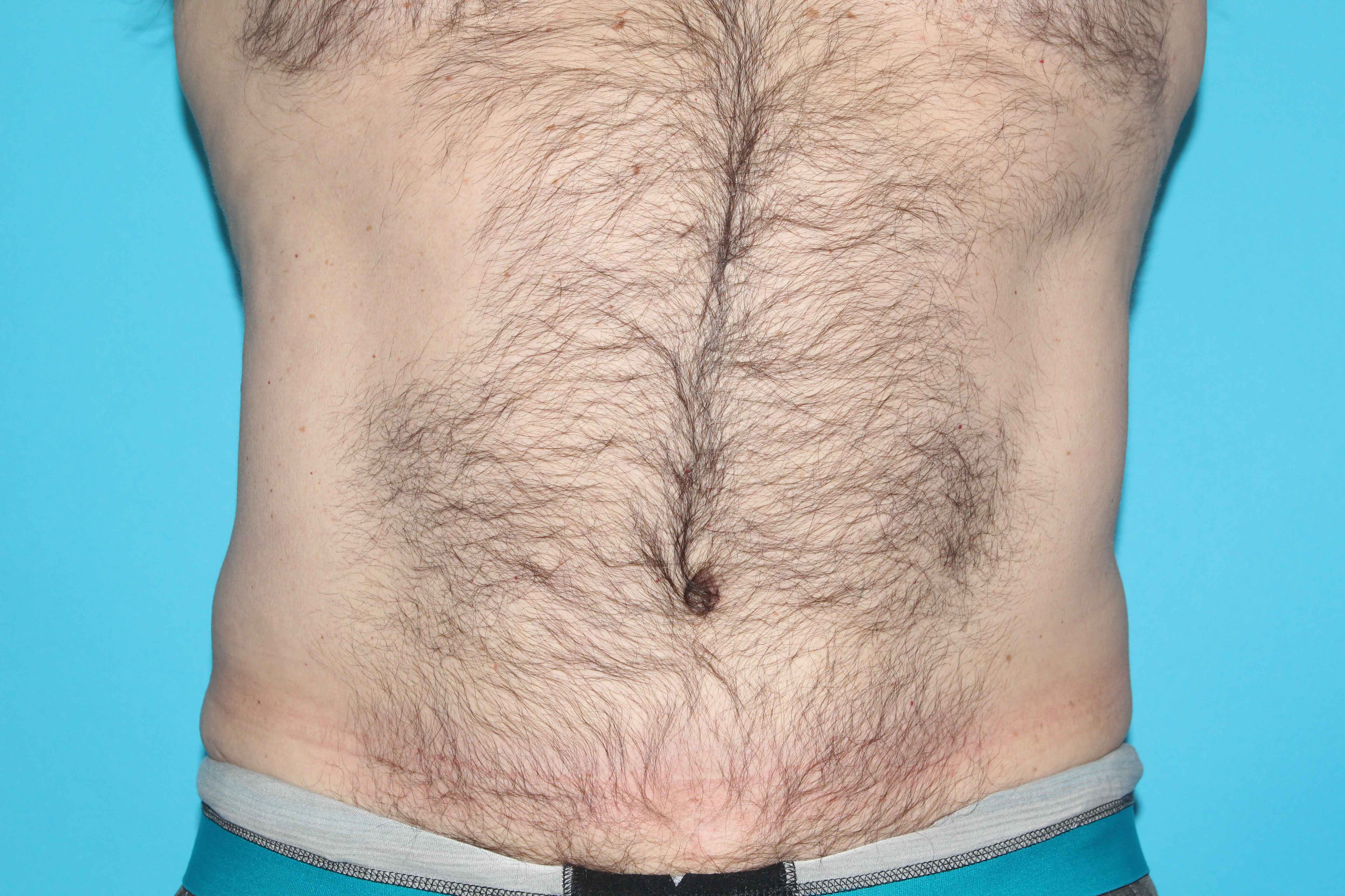 Tummy Tuck (Lipoabdominoplasty) Before & After Patient #1805