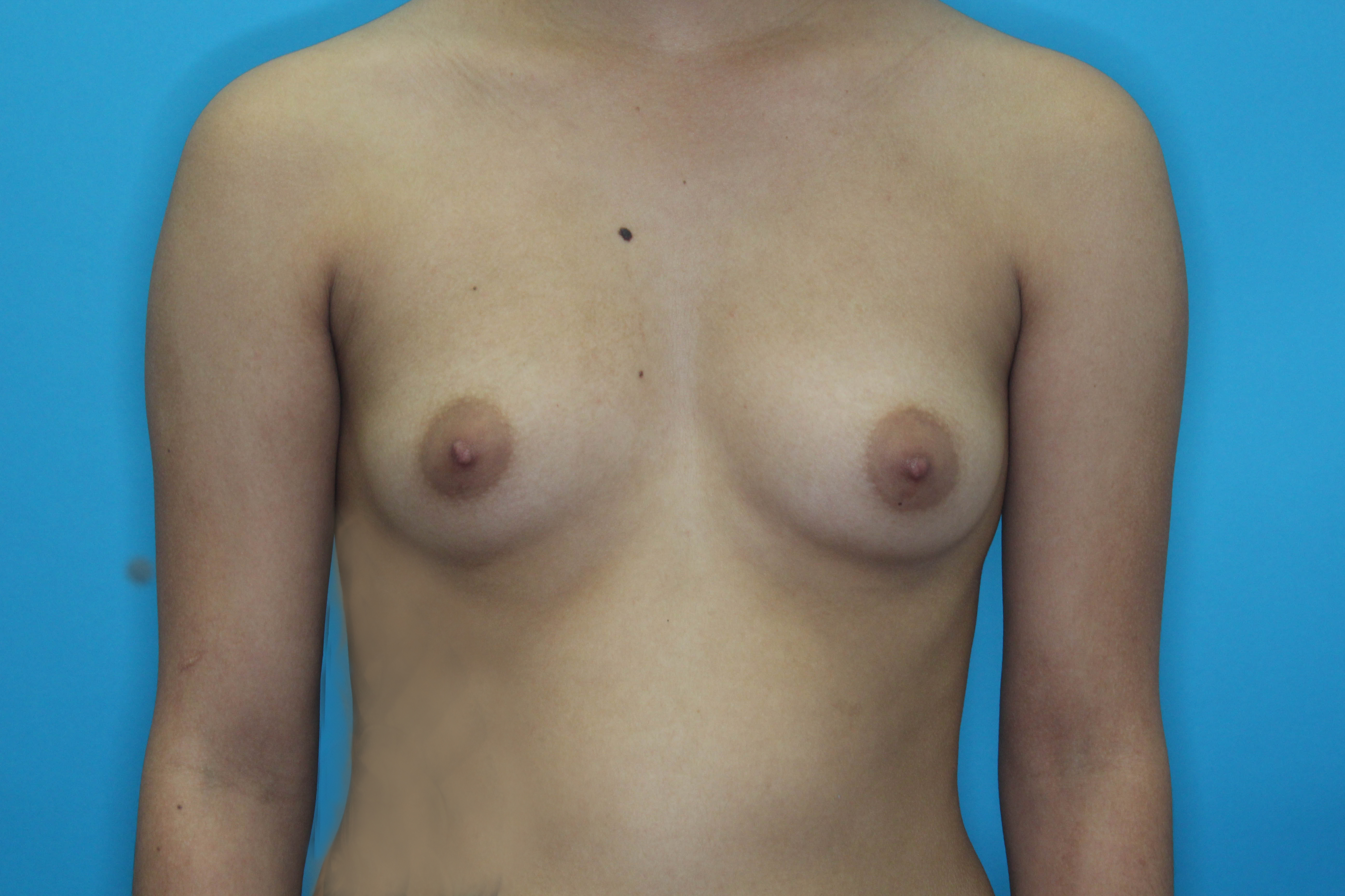 Breast Augmentation with Implant Before & After Patient #1871