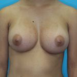 Breast Augmentation with Implant Before & After Patient #1871