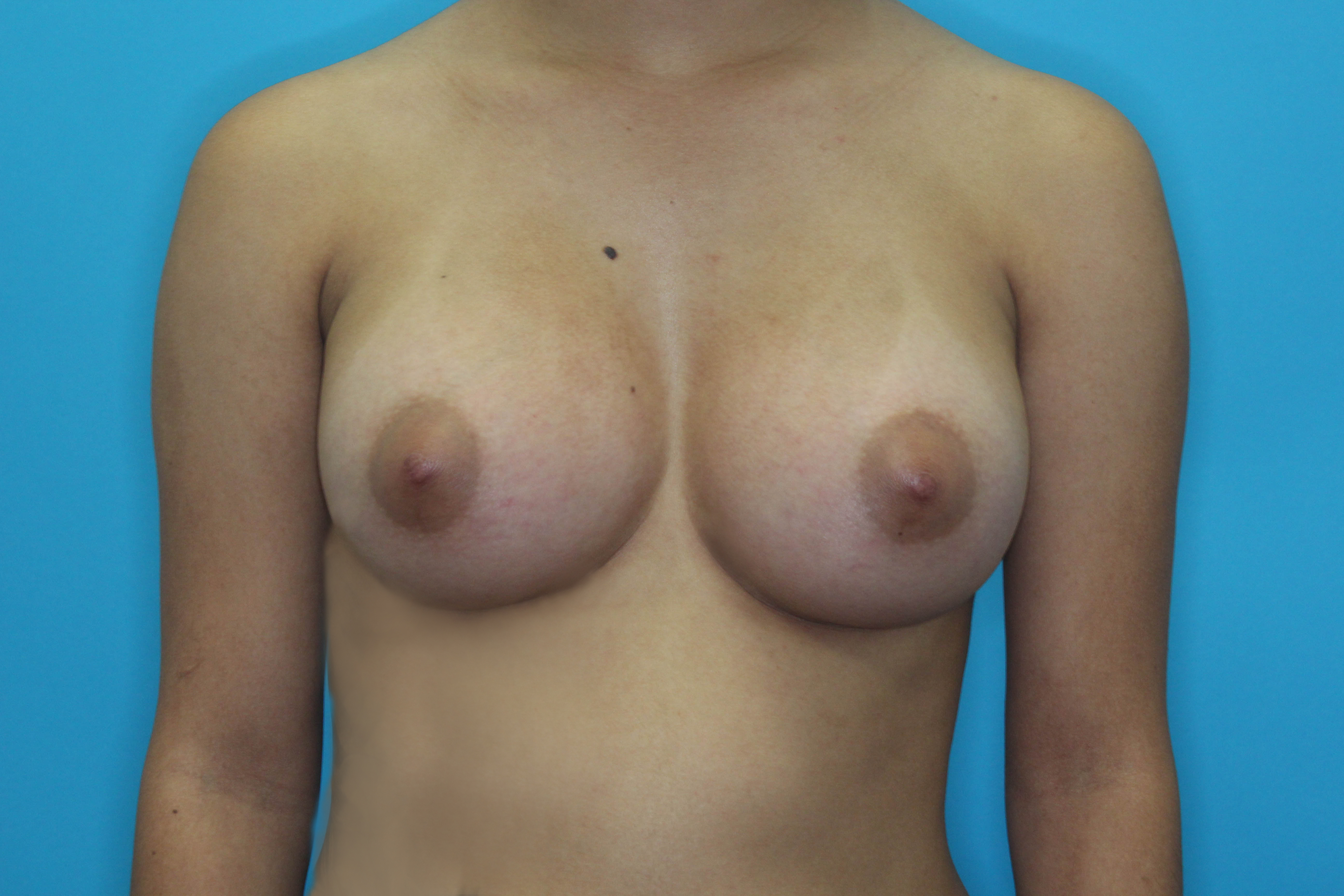 Breast Augmentation with Implant Before & After Patient #1871