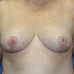 Breast Lift (Mastopexy) Before & After Patient #1889