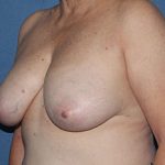 Breast Lift (Mastopexy) Before & After Patient #1889