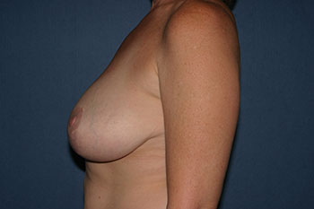 Breast Lift (Mastopexy) Before & After Patient #1882