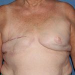 Breast Reconstruction (Fat Only) Before & After Patient #1903