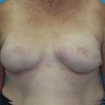 Breast Reconstruction (Fat Only) Before & After Patient #1903