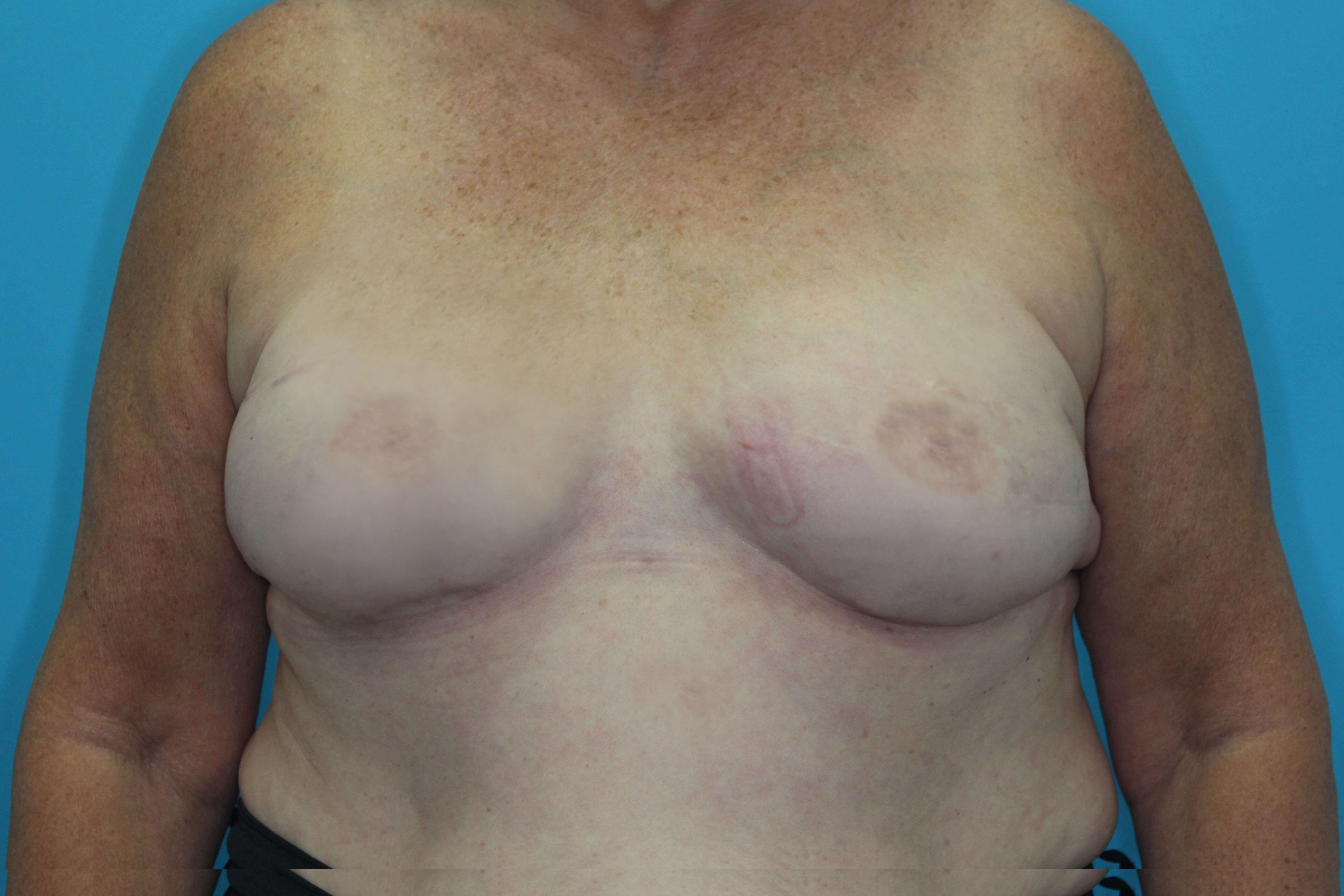 Breast Reconstruction (Fat Only) Before & After Patient #1903