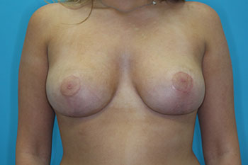 Breast Reduction Before & After Patient #1913