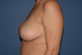 Breast Reduction Before & After Patient #1906