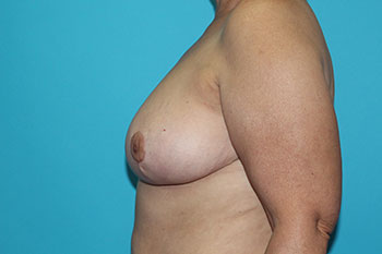 Breast Reduction with Auto Augmentation Before & After Patient #1925