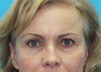 Brow Lift Before & After Patient #2061