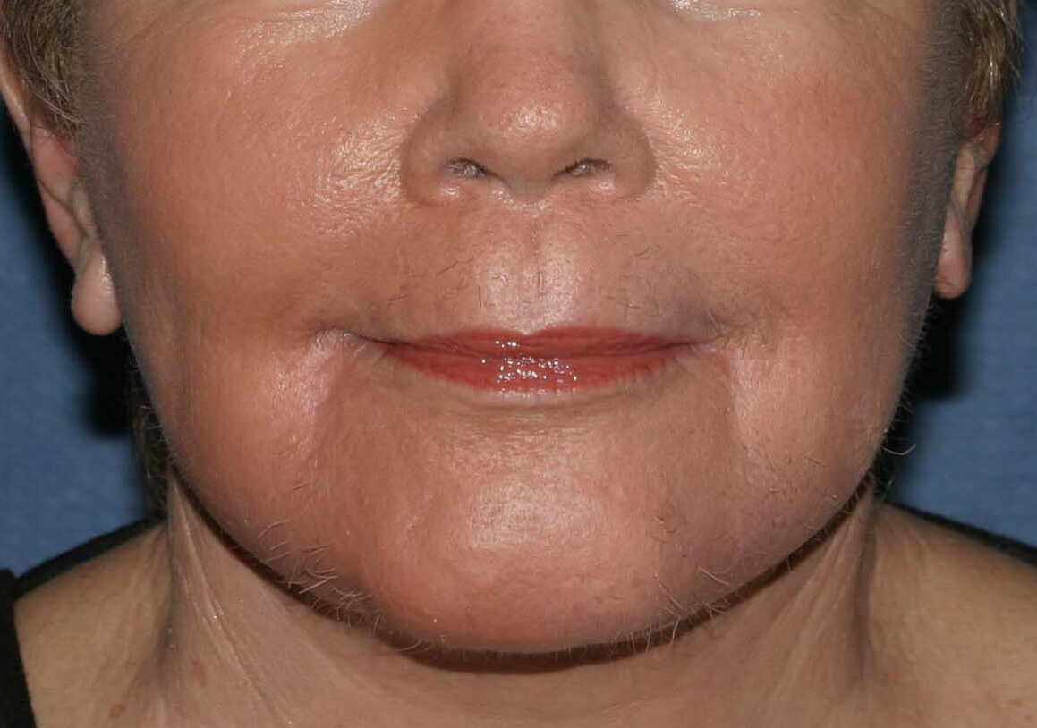 Laser Resurfacing Before & After Patient #2242
