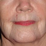 Laser Resurfacing Before & After Patient #2242