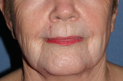 Laser Resurfacing Before & After Patient #2242