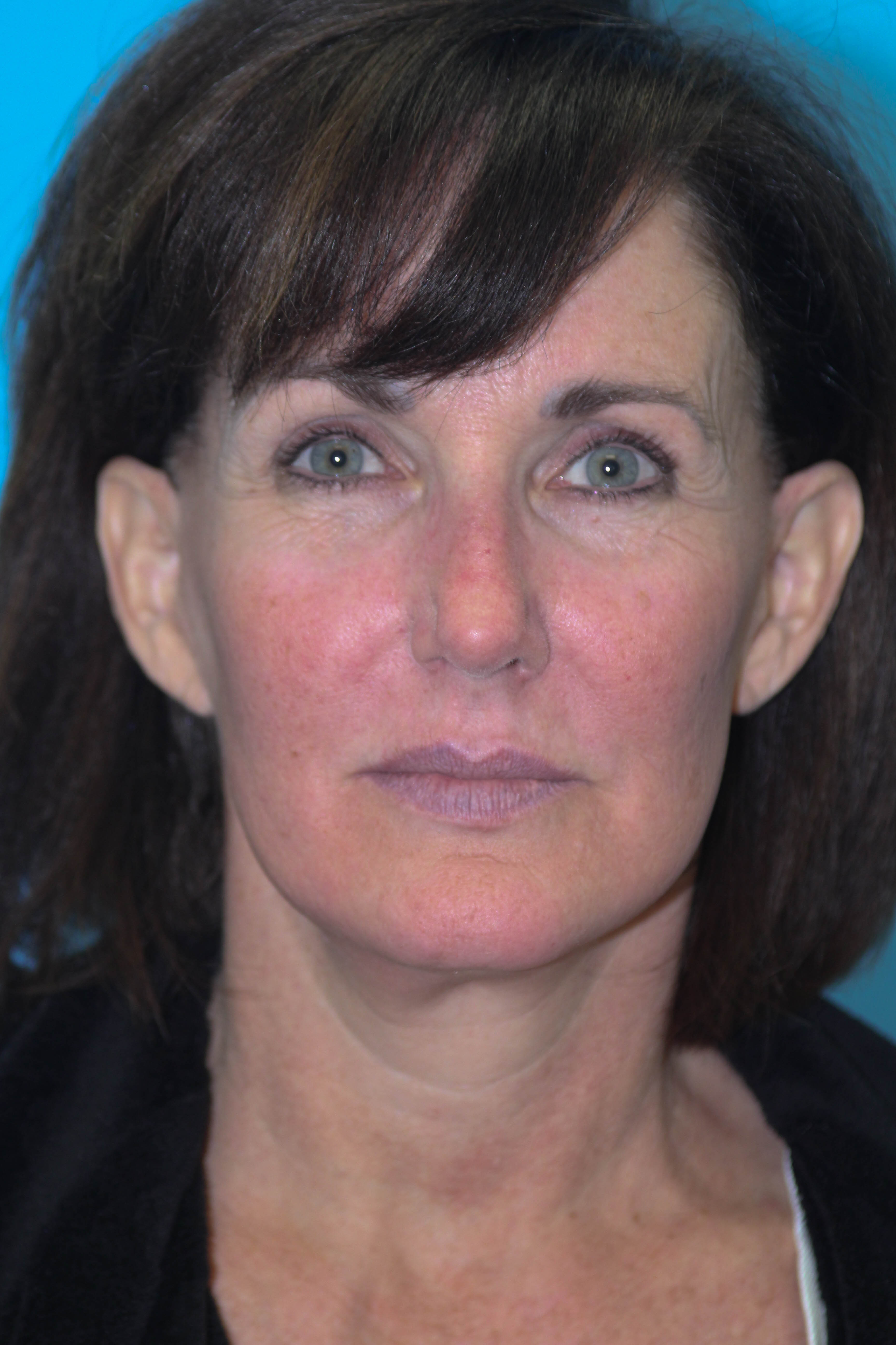 Face Before & After Patient #1714