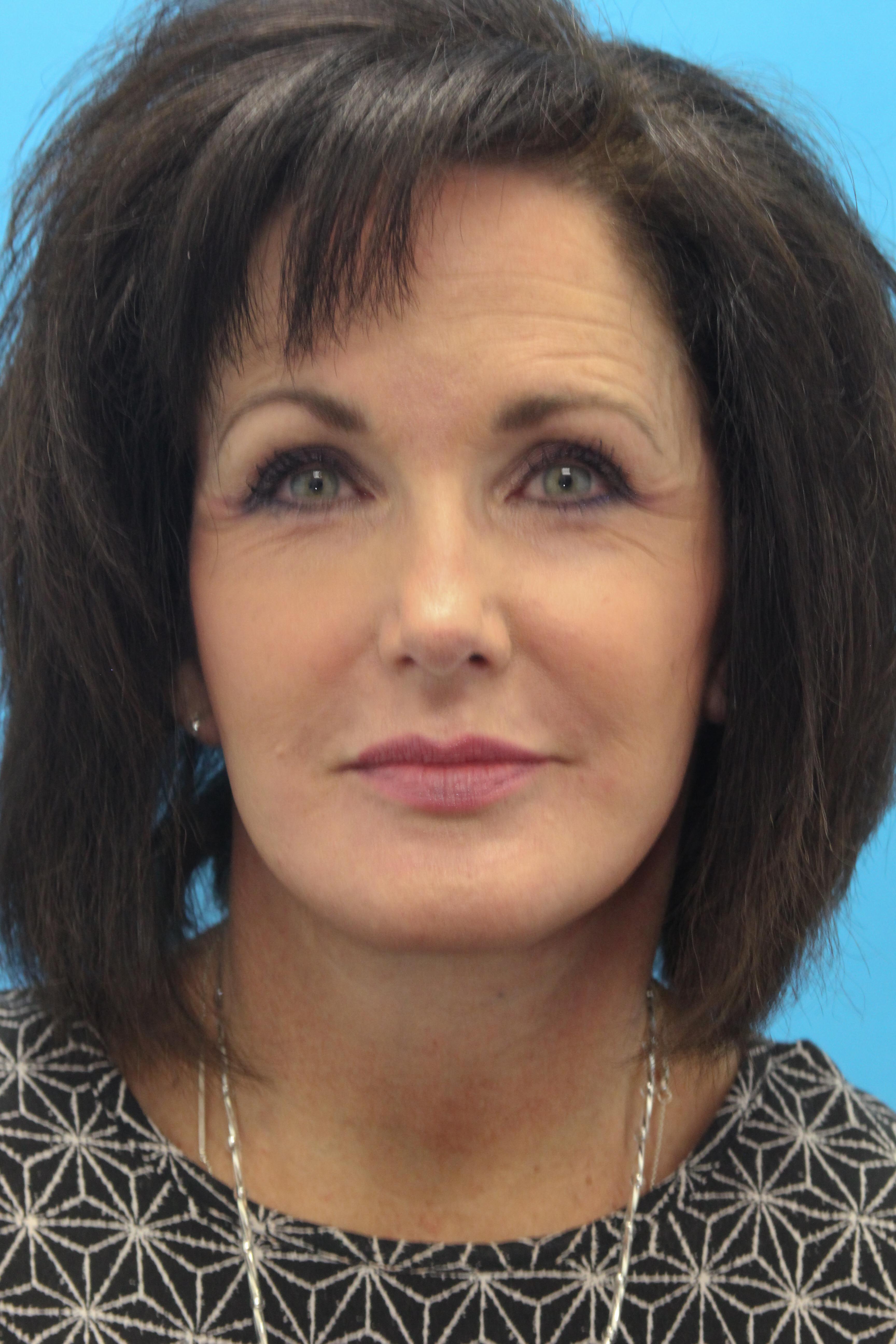 Face Before & After Patient #1714