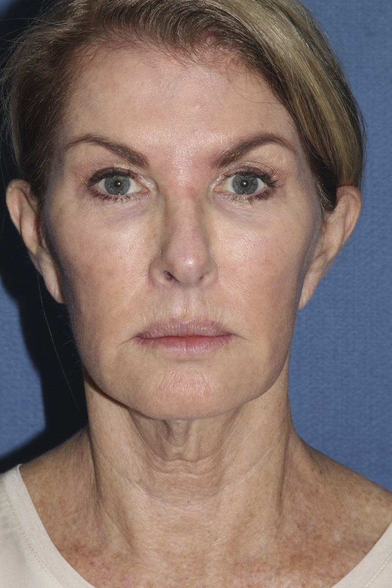 Face Before & After Patient #1721