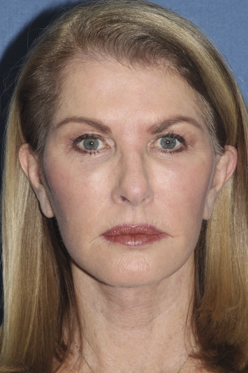 Face Before & After Patient #1721