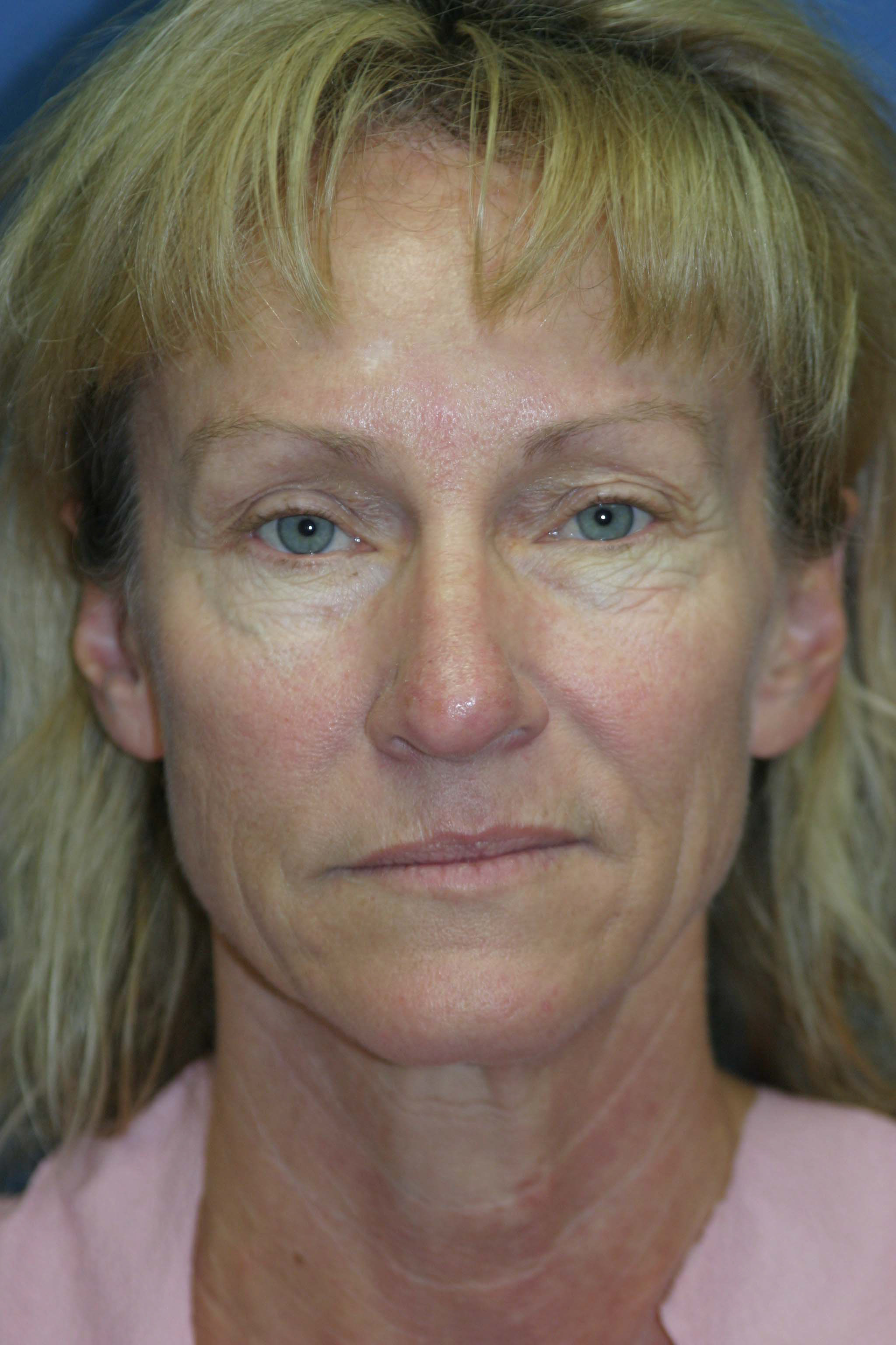 Face Before & After Patient #1728