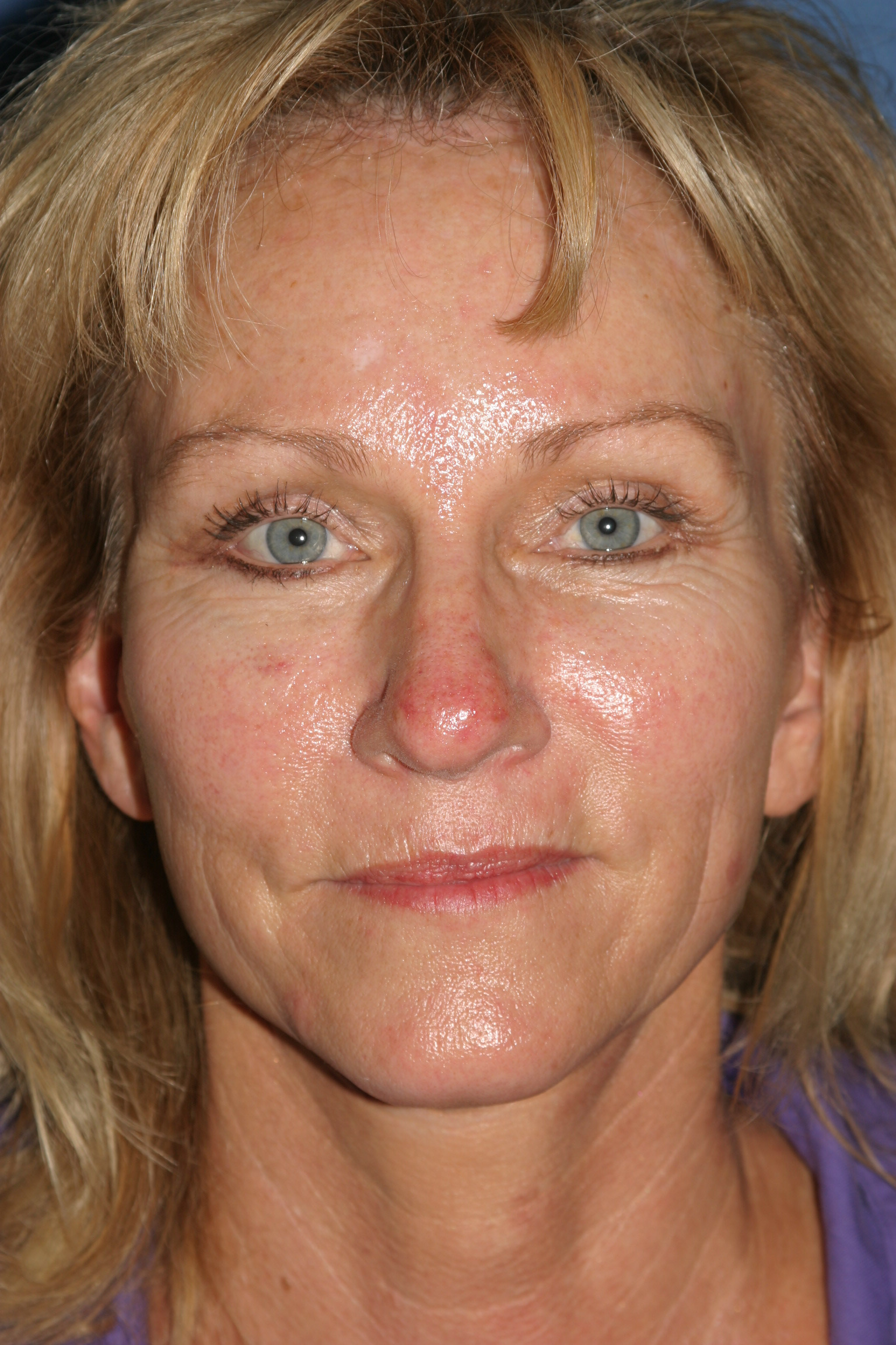 Face Before & After Patient #1728