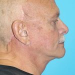 Facelift Before & After Patient #1674