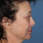 Face Before & After Patient #1693