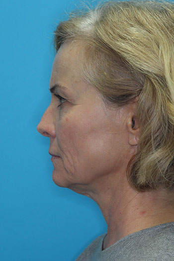 Face Before & After Patient #1764