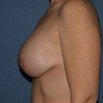 Breast Before & After Patient #1846