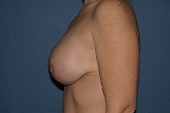 Breast Before & After Patient #1846