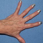 Hand Rejuvenation Before & After Patient #1983