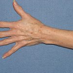 Hand Rejuvenation Before & After Patient #1991