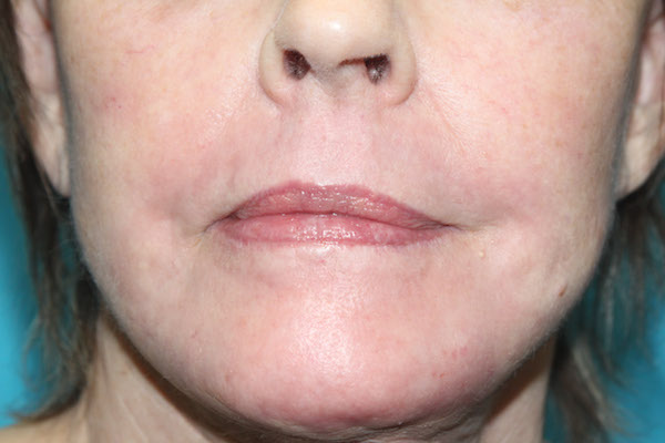 Croton Peel Before & After Patient #2239